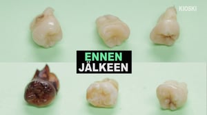 Kioski trending: Näin virvoitusjuomat tuhoavat hampaasi