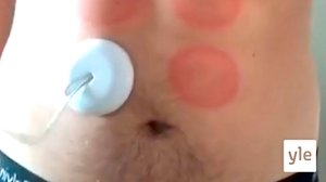 Mulle tehtiin 6-pack synnytysimukupilla: 08.12.2019 10.34