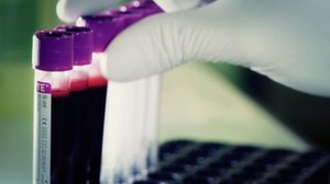 Verikoe paljastaa keuhkosyövän (S): 17.10.2018 13.14