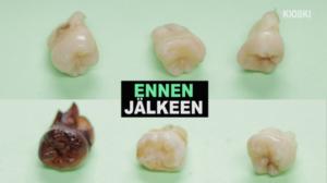 Kioski trending: Näin virvoitusjuomat tuhoavat hampaasi