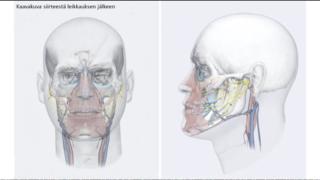 Yle Uutisluokka Triplet: Pohjoismaiden ensimmäinen kasvojensiirto vaati yli 30 hengen leikkaustiimin – ulkonäkö ei siirry kasvojen myötä (S): 23.02.2016 11.33